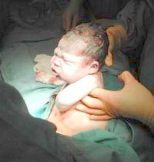 Picture 1 of The method of caesarean section causes many risks for pregnant women and the fetus