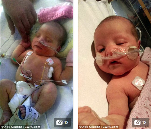 Picture 1 of The miraculous vitality of a girl was born with only 35ml of blood in her body