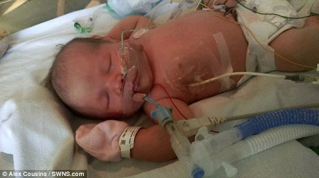 Picture 2 of The miraculous vitality of a girl was born with only 35ml of blood in her body
