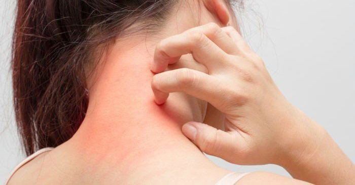 Picture 1 of The more the cause of itching, the more it causes itching