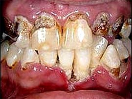 Picture 2 of The more you drink, the easier it is to damage tooth enamel