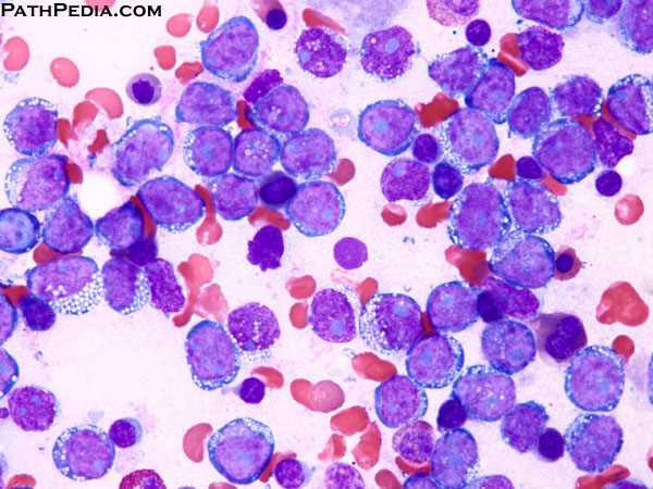 Picture 2 of The most common cancer in children turns out to be preventable