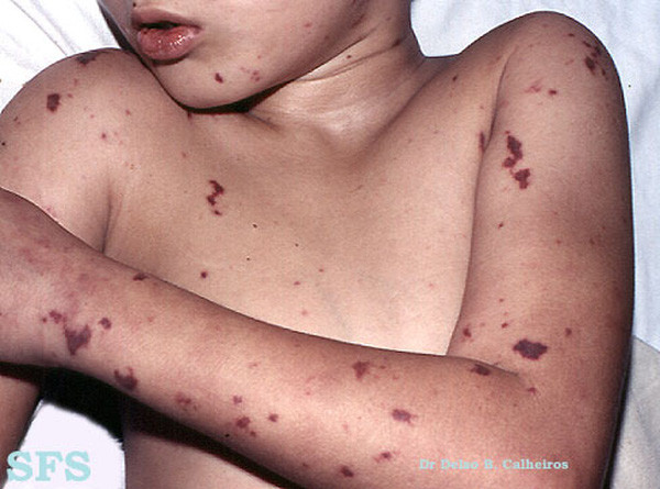 Picture 3 of The most complete and detailed information about meningococcal meningitis