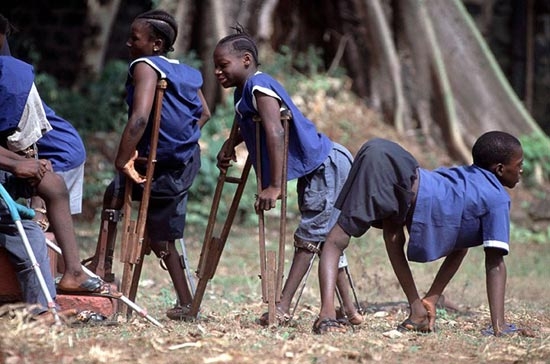 Picture 3 of The most terrible diseases of all time