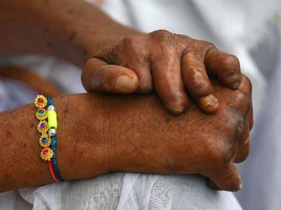 Picture 5 of The most terrible diseases of all time