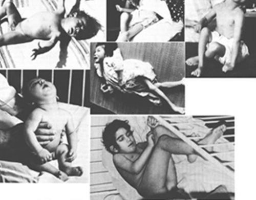 Picture 2 of The most terrible strange disease of Japanese history due to the release of mercury into the sea