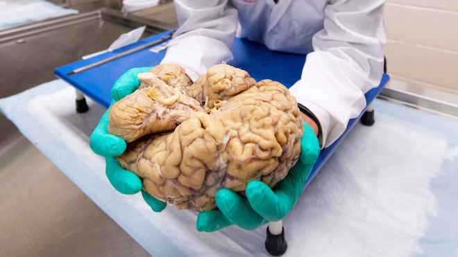 The mysterious disease is only diagnosed after the patient has died, because the doctor needs to cut their brain images 1