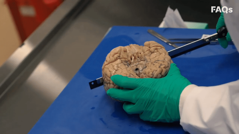 The mysterious disease is only diagnosed after the patient has died, because the doctor needs to cut their brain images 3