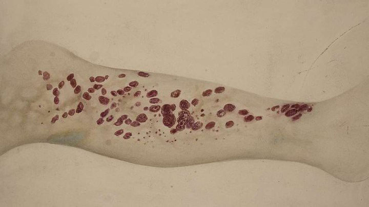 Picture 1 of The mysterious disease that killed many pirates in the 18th century is gradually appearing