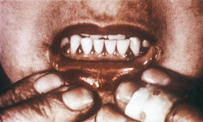 Picture 3 of The mysterious disease that killed many pirates in the 18th century is gradually appearing