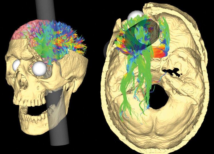Picture 2 of The mystery in a person's brain is pierced through his head