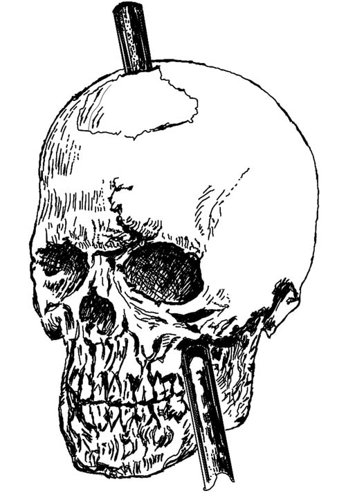 Picture 3 of The mystery in a person's brain is pierced through his head