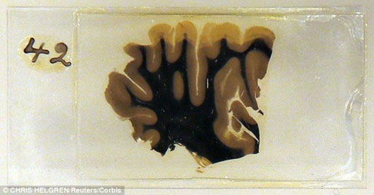 Picture 3 of The new finding contrasts with Einstein's brain