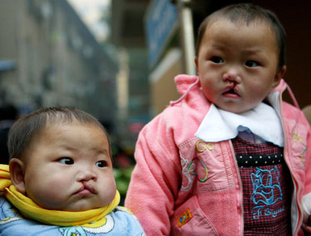 Picture 1 of The number of Chinese children with disabilities increased because of pollution