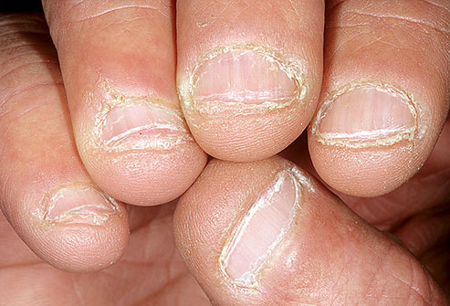 Picture 10 of The odd odd under the nail