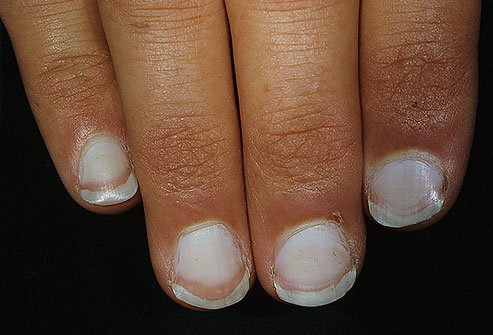Picture 3 of The odd odd under the nail