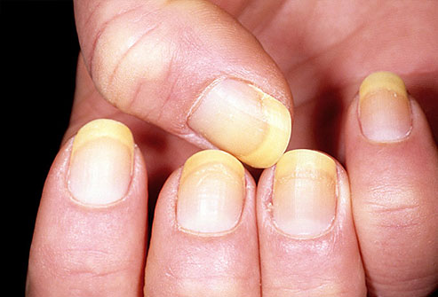 Picture 4 of The odd odd under the nail