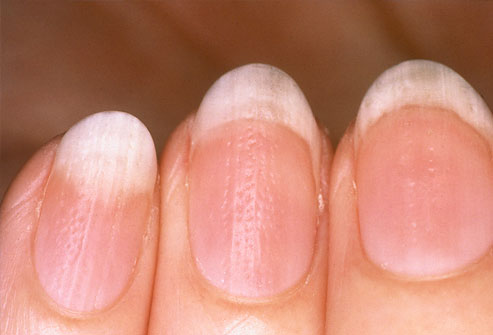 Picture 6 of The odd odd under the nail