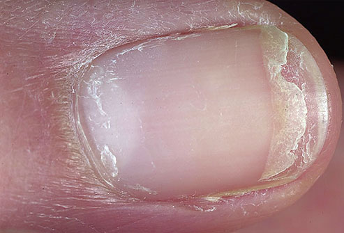 Picture 7 of The odd odd under the nail