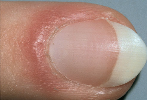 Picture 8 of The odd odd under the nail