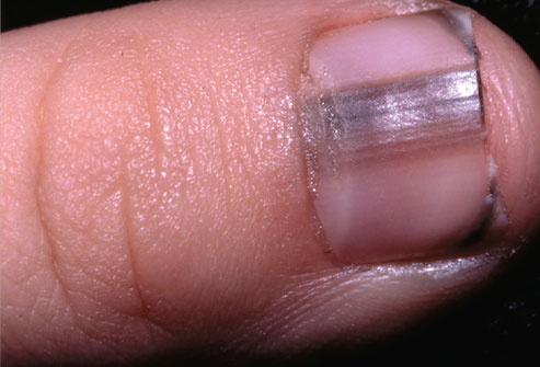 Picture 9 of The odd odd under the nail