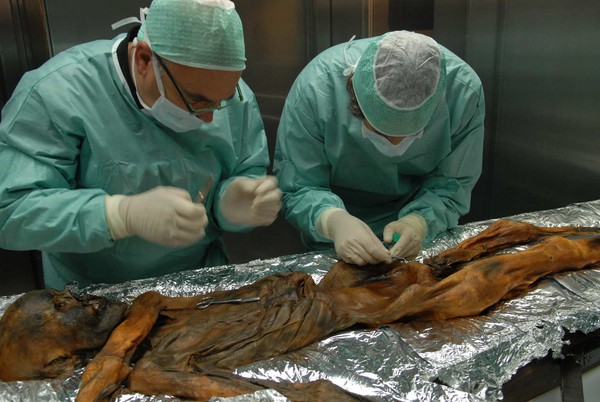Picture 3 of The oldest blood cell on the Otzi ice mummy