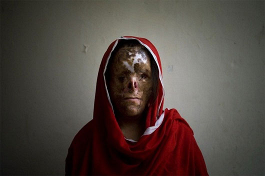 Picture 5 of The process of concentrated acid destroys the human body