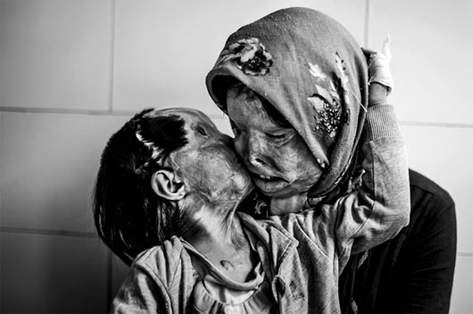 Picture 7 of The process of concentrated acid destroys the human body