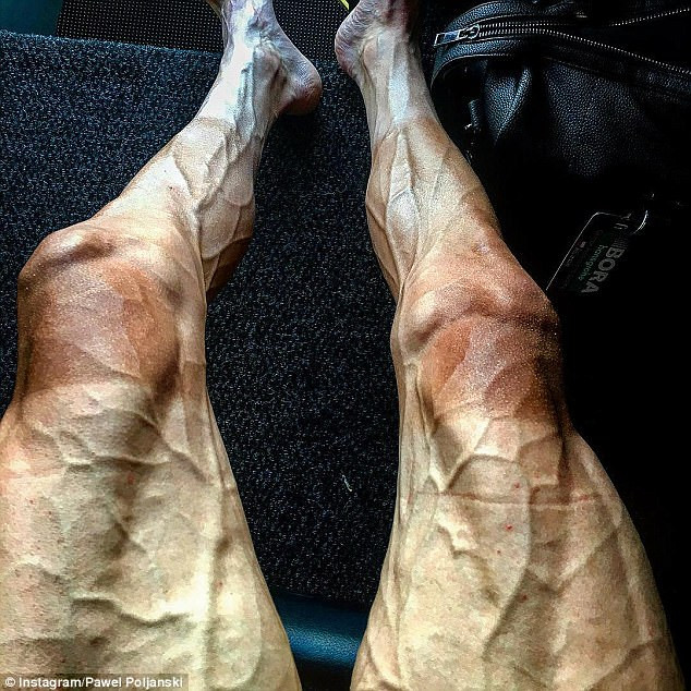 Picture 1 of The reason why the athlete's foot is horribly deformed