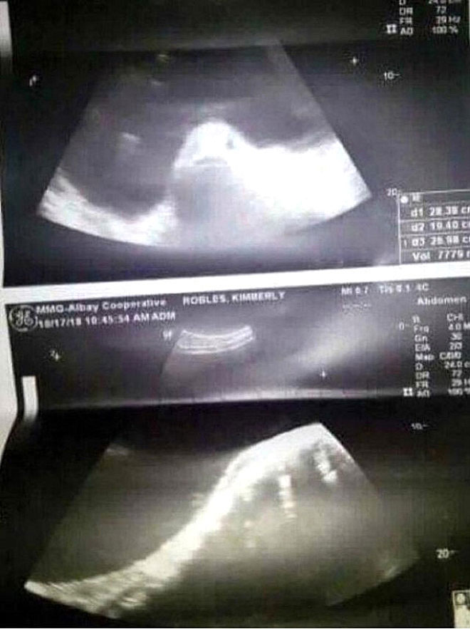 Picture 3 of The scary truth behind the ultrasound photo of