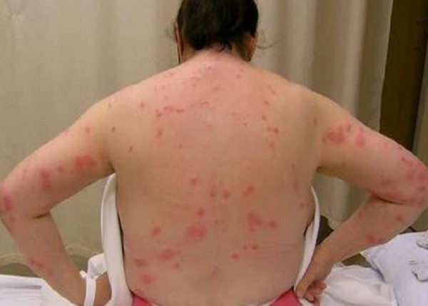 Picture 4 of The secret to destroy bed bugs without chemicals
