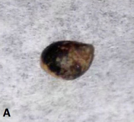Picture 1 of The snail grows in the body through the wound