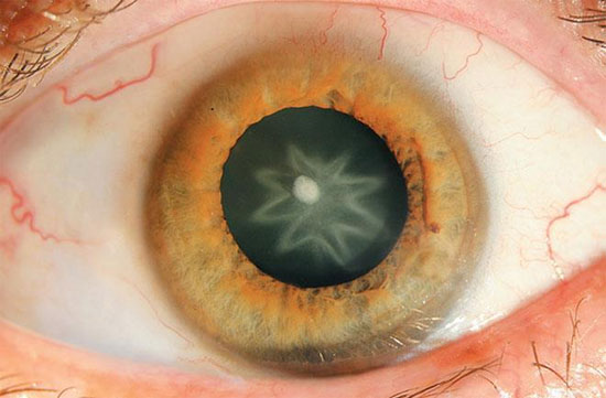 Picture 1 of The star appears in the eye after being punched