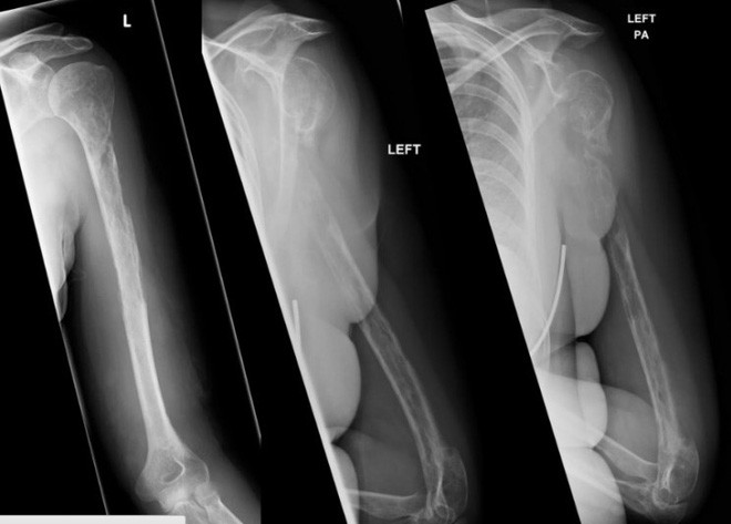 Picture 1 of The strange disease caused the patient's bones to