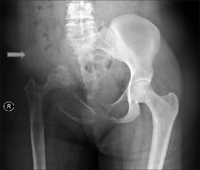 Picture 2 of The strange disease caused the patient's bones to