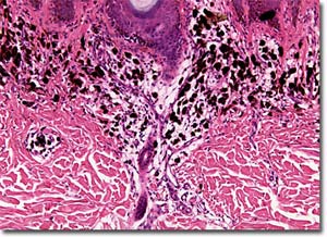 Picture 1 of The survival rate in patients with melanoma has improved