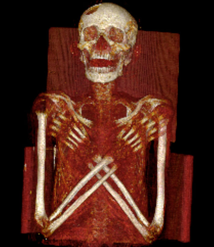 Picture 1 of The terrible disease on ancient Egyptian mummies