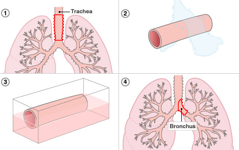 Picture 2 of The tissue transplant has 'renewed' a Belgian