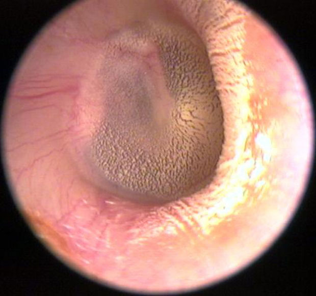 Picture 9 of The truth about the earwax method is said to be