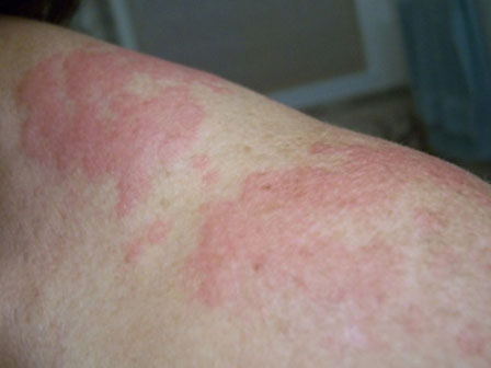 Picture 2 of The truth is less known about allergies