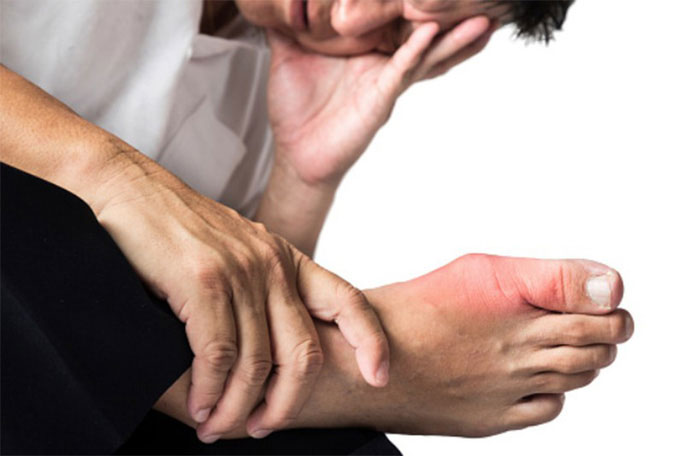 Picture 1 of The unexpected cause makes many people susceptible to gout