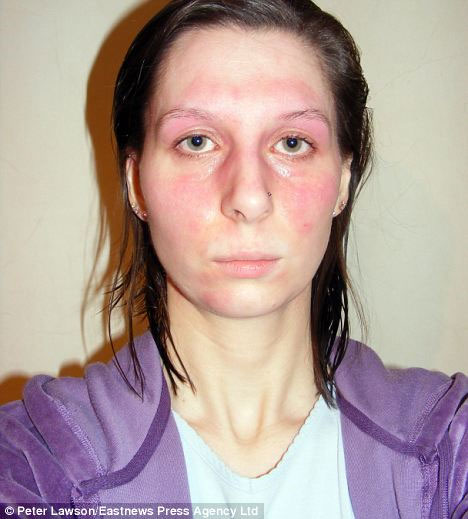 Picture 1 of The woman is allergic to almost everything
