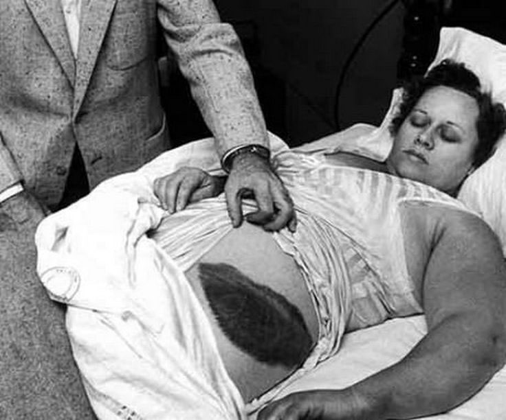 Picture 1 of The woman who was hit by a meteorite