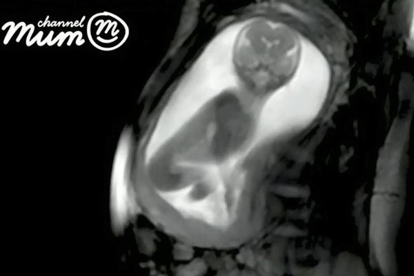 Picture 4 of The world's best ultrasound technology helps detect abnormalities in the fetus