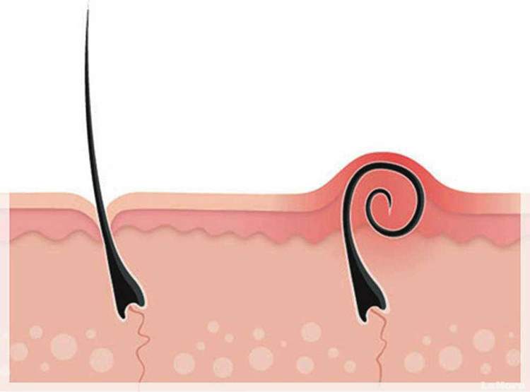Picture 1 of The worrisome consequences of tweezers are tweezers