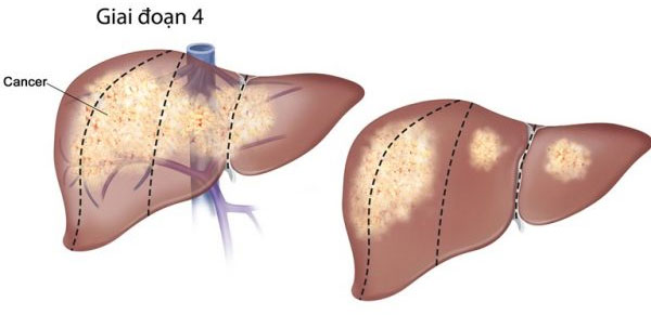 Picture 3 of There are several stages in cirrhosis?  What are acute cirrhosis f1, f2, f3, f4?