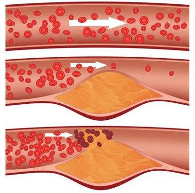 Picture 2 of There was medicine for heart attack and stroke