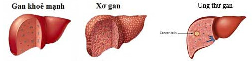Picture 2 of Things to know about liver cancer