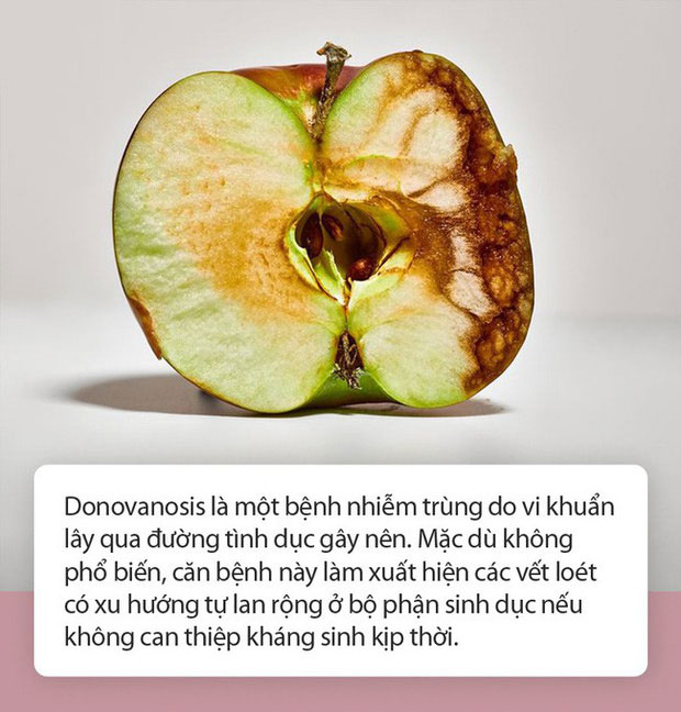 Picture 1 of Things to know about sexually transmitted diseases can 'eat people'