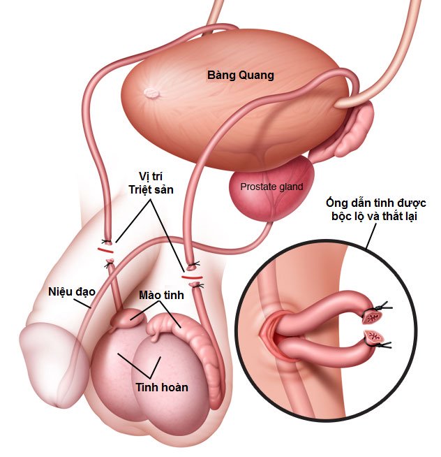 Picture 2 of Things to know about sterilization in men and women